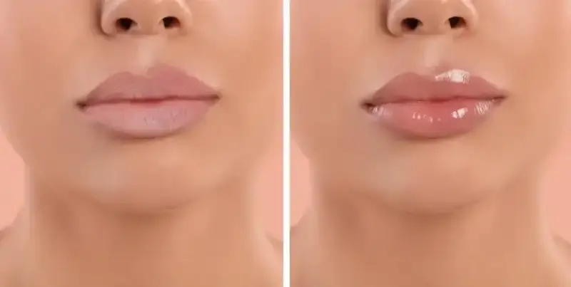 Botox Result